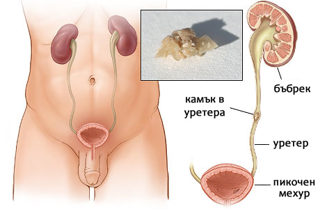 камъни в бъбреците