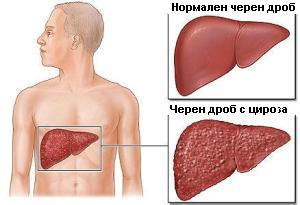 цироза на черния дроб